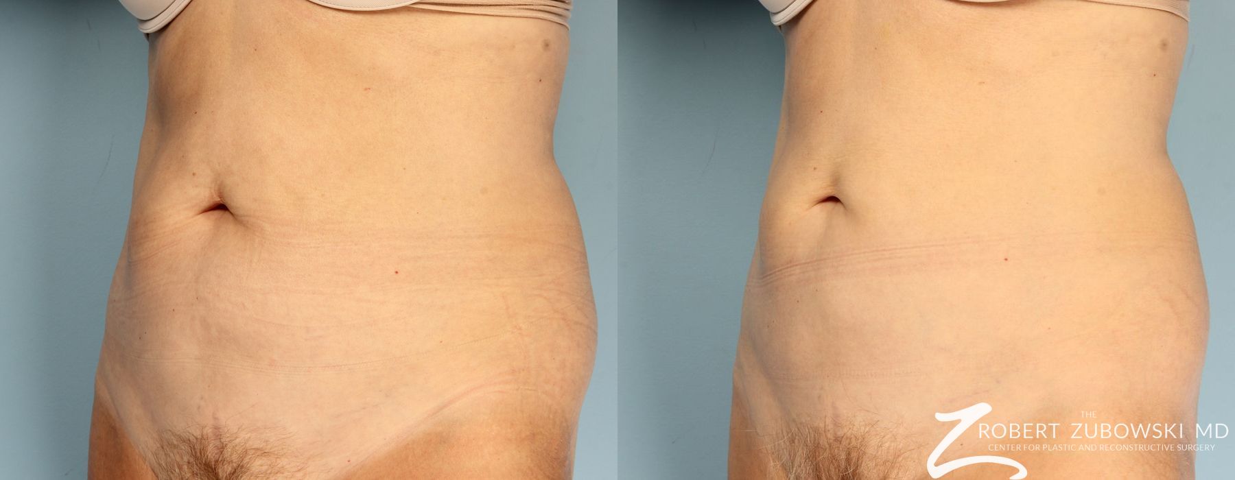 CoolSculpting® - Thumbnail 3