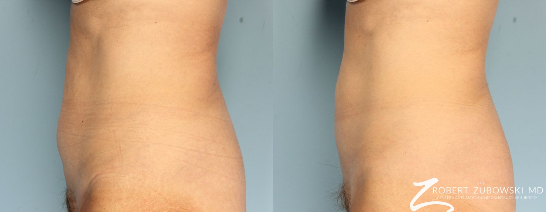 CoolSculpting® - Thumbnail 2