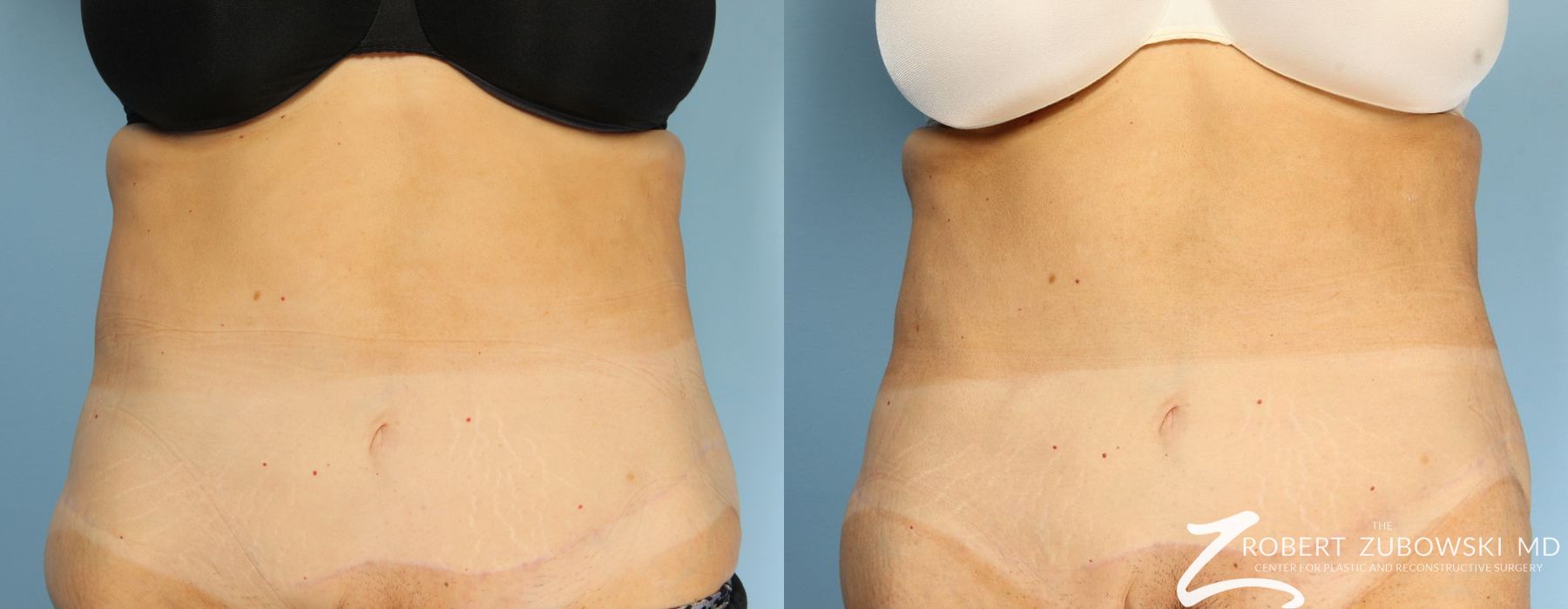 CoolSculpting® - Case 3906