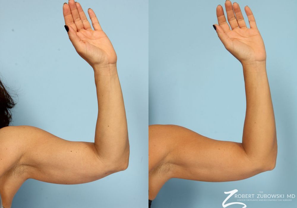 CoolSculpting® - Case 3911