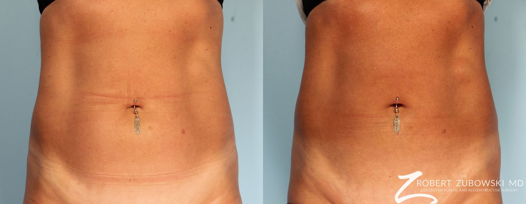 CoolSculpting® - Case 3907