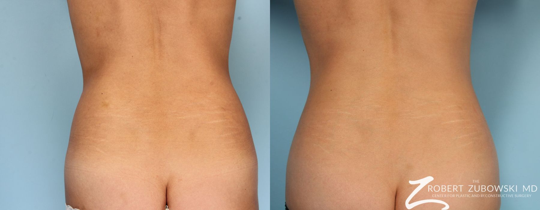 CoolSculpting® - Thumbnail 2