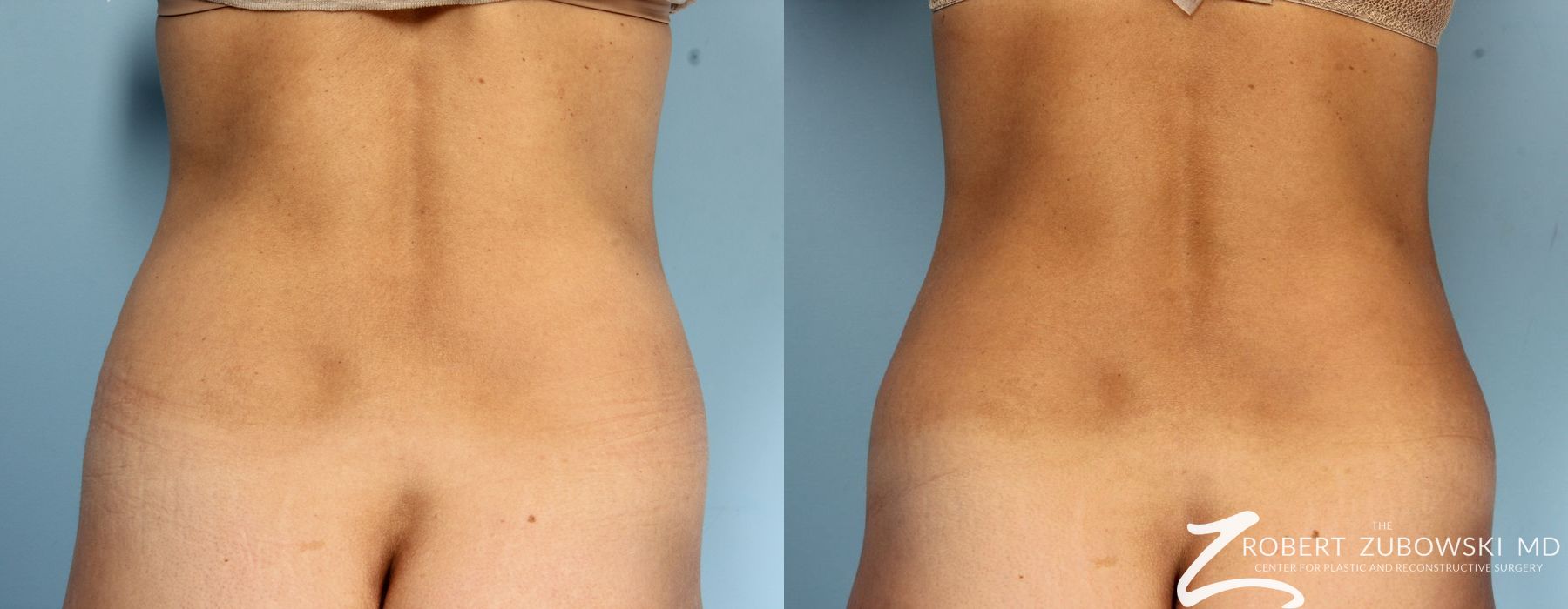 CoolSculpting® - Thumbnail 2