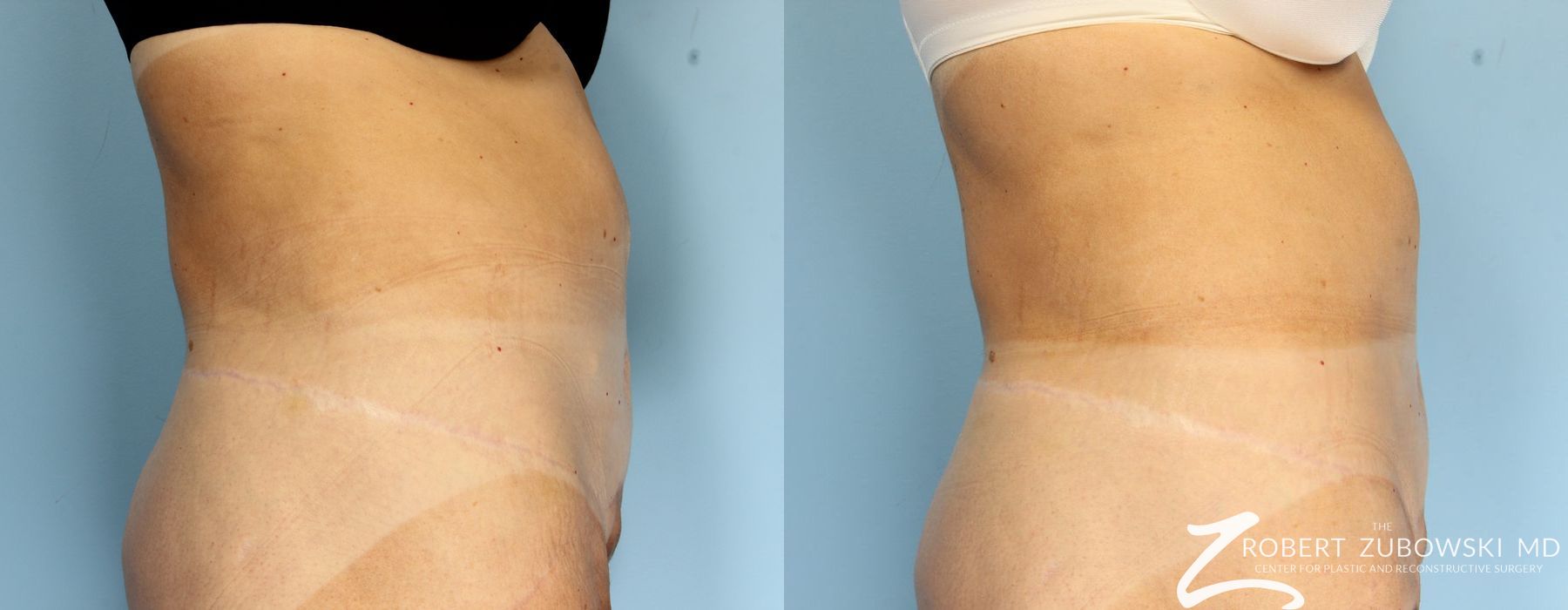 CoolSculpting® - Thumbnail 2