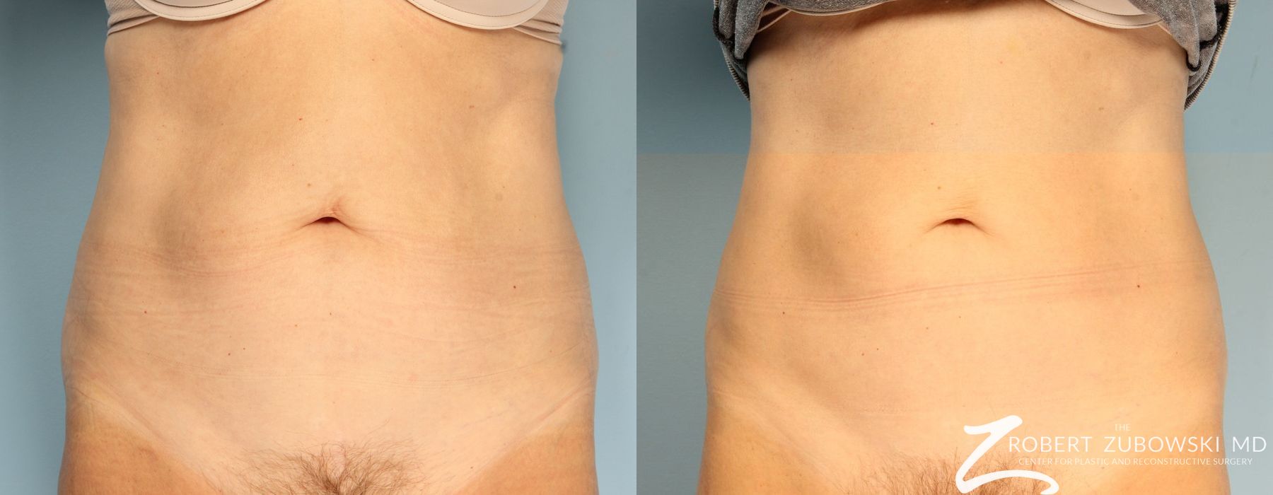 CoolSculpting® - Case 3908