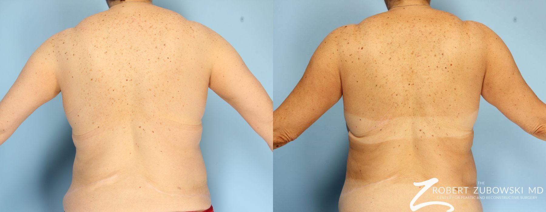 CoolSculpting® - Thumbnail 3