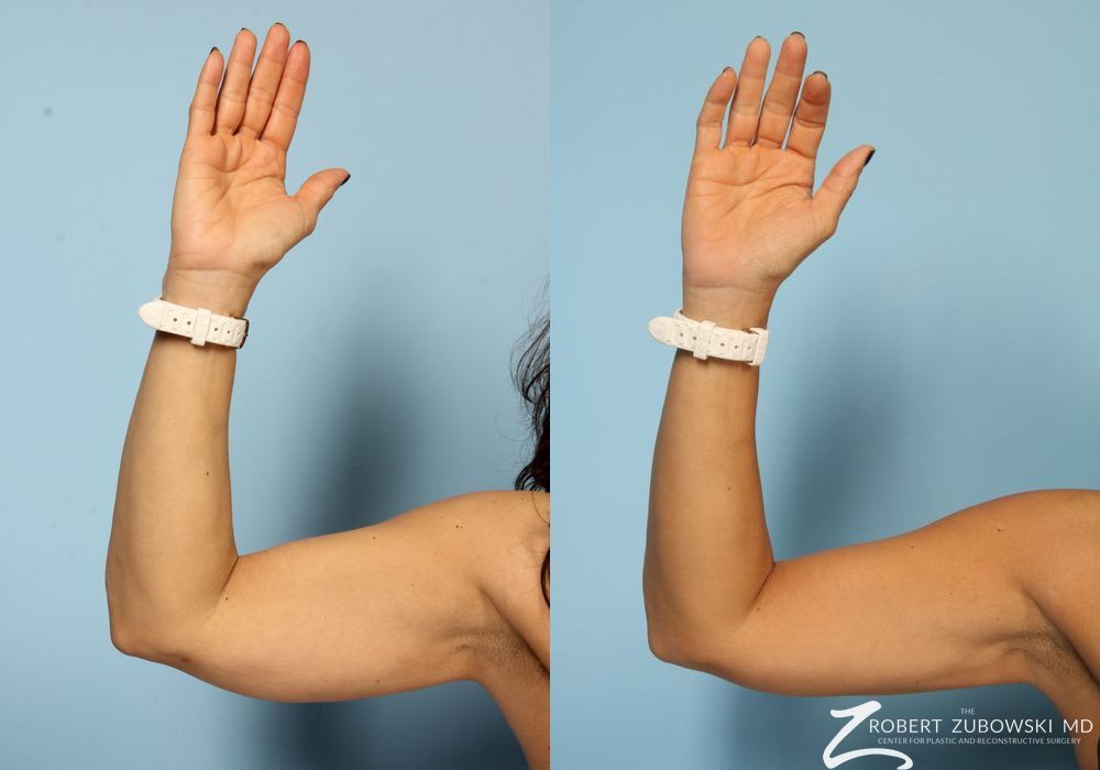 CoolSculpting® - Thumbnail 2