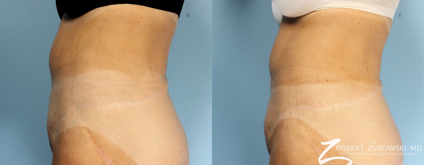 CoolSculpting® - Thumbnail 4