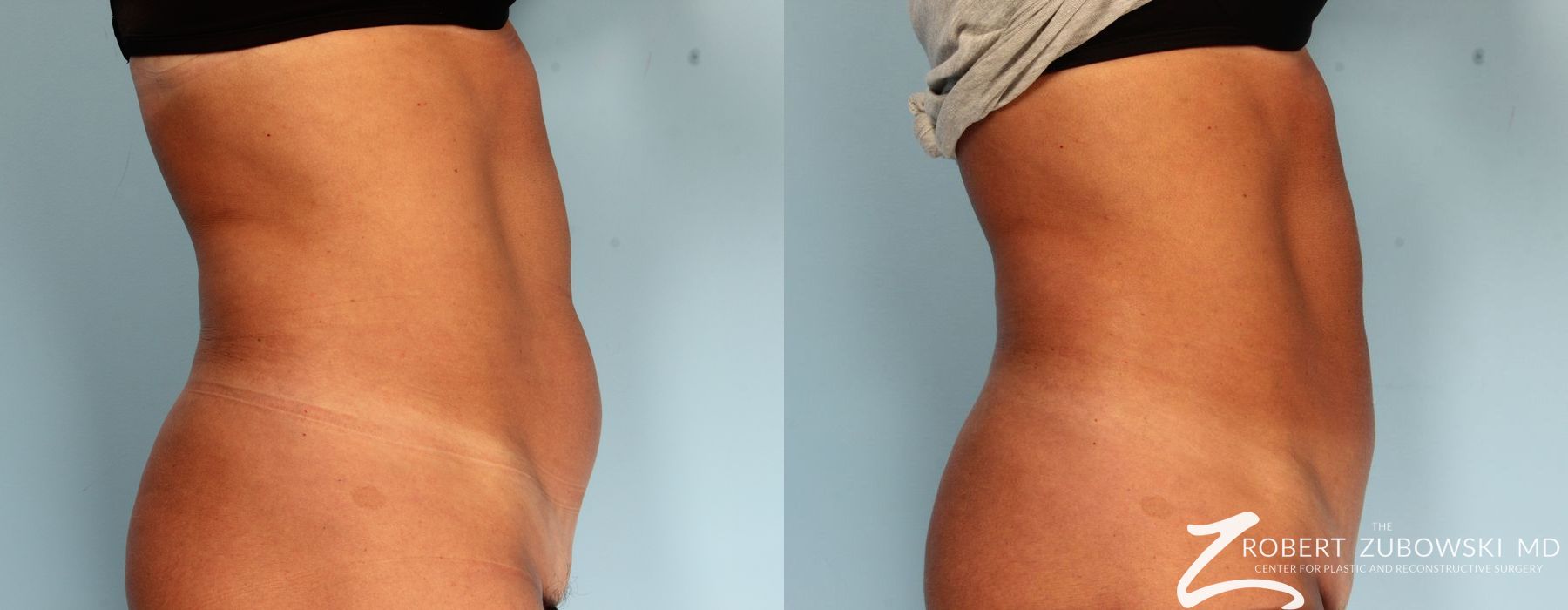 CoolSculpting® - Thumbnail 2