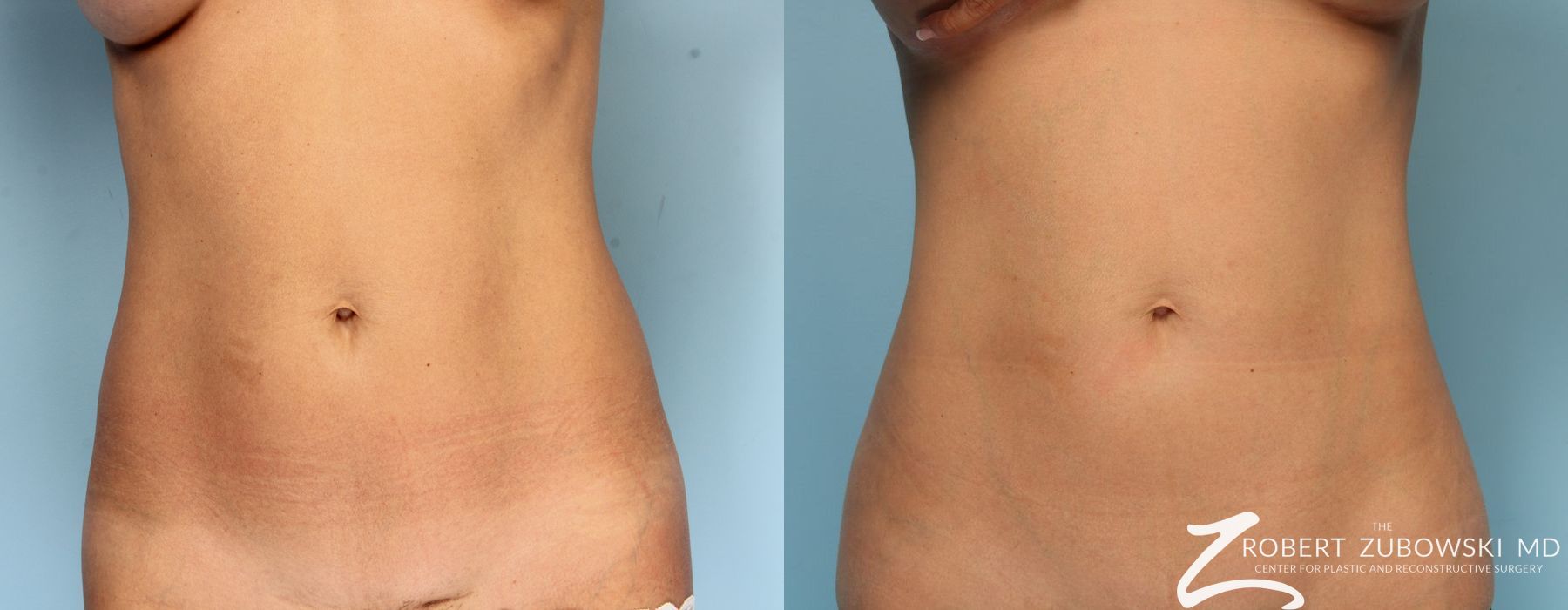 CoolSculpting® - Case 3910