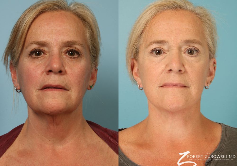 Facelift - Case 3824
