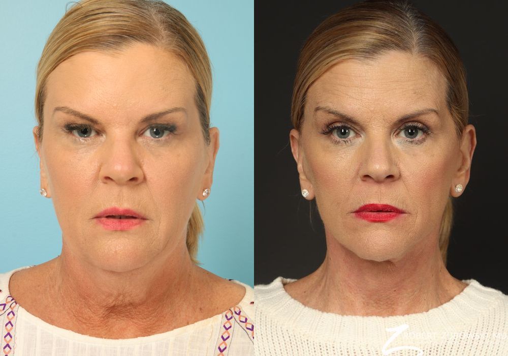 Facelift - Case 3828