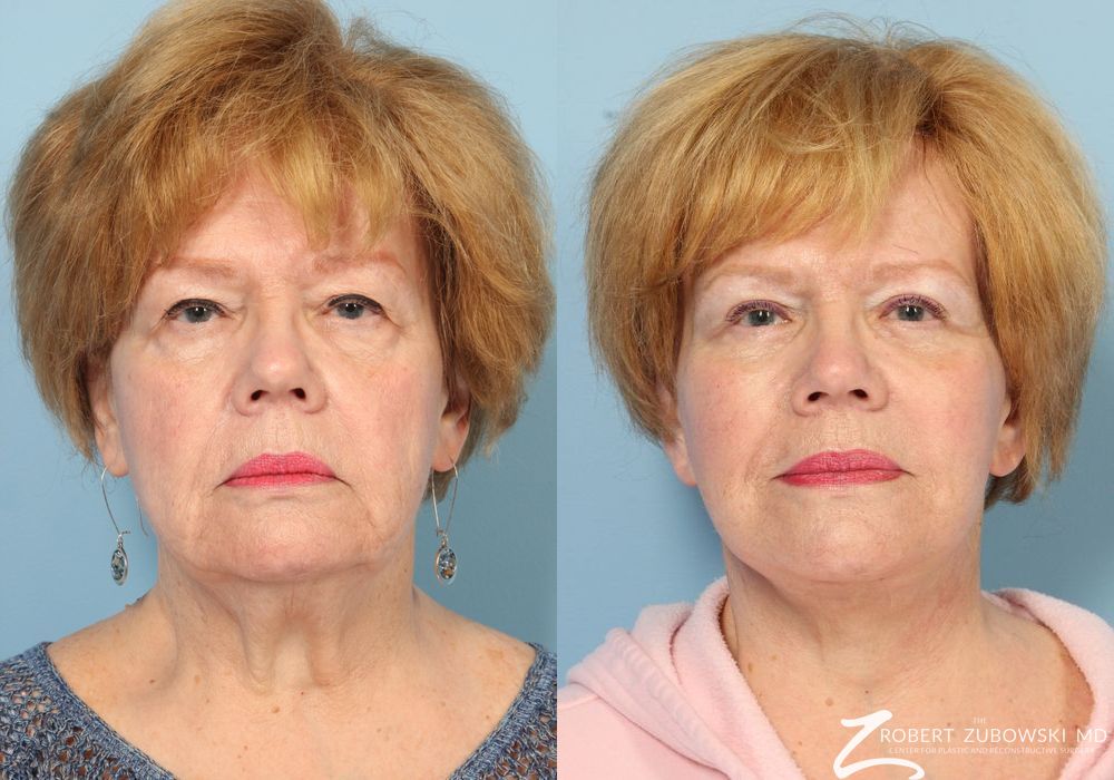 Facelift - Case 3818