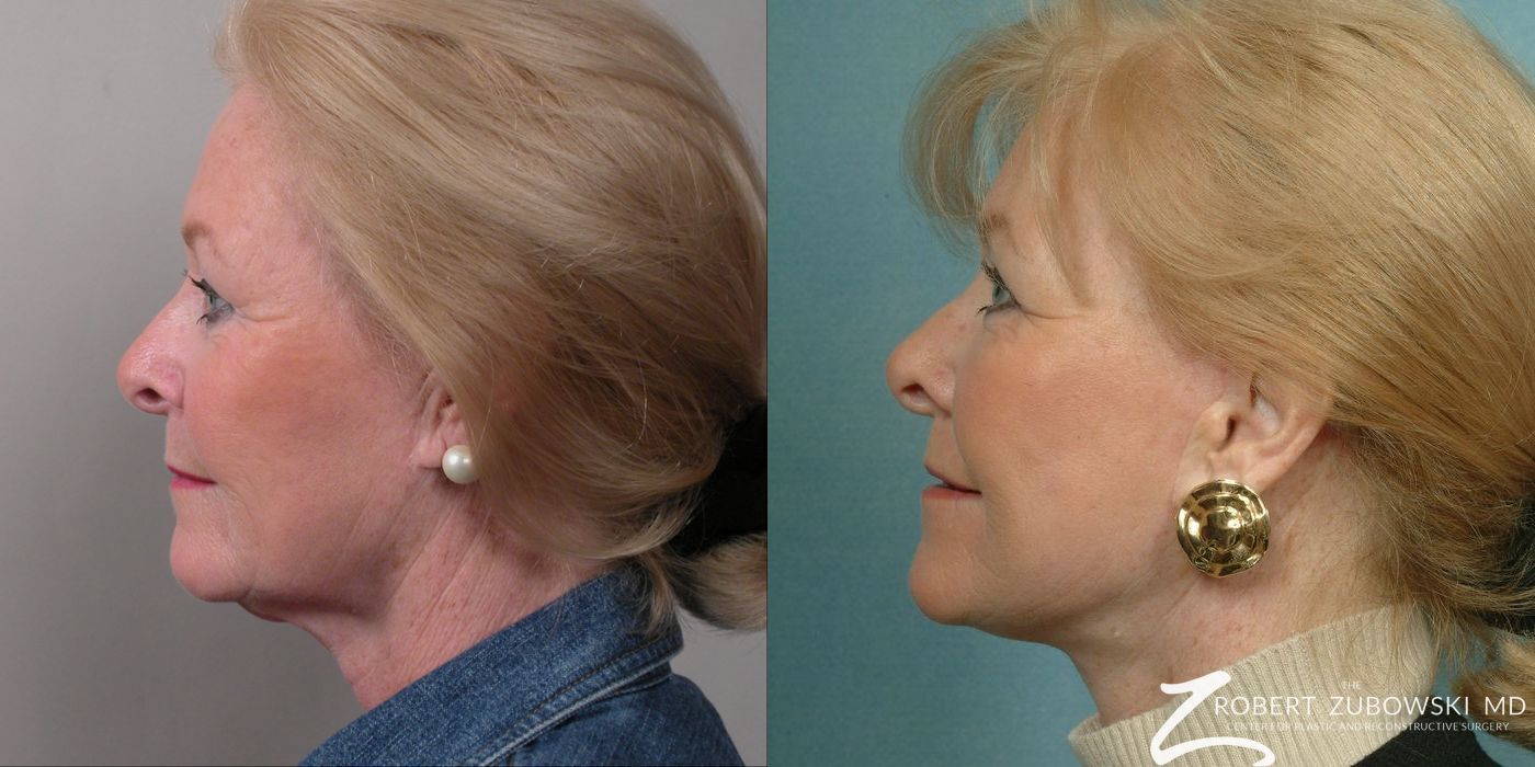 Facelift - Thumbnail 2