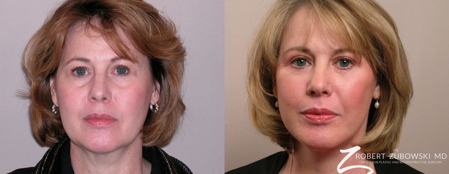 Facelift - Case 3811