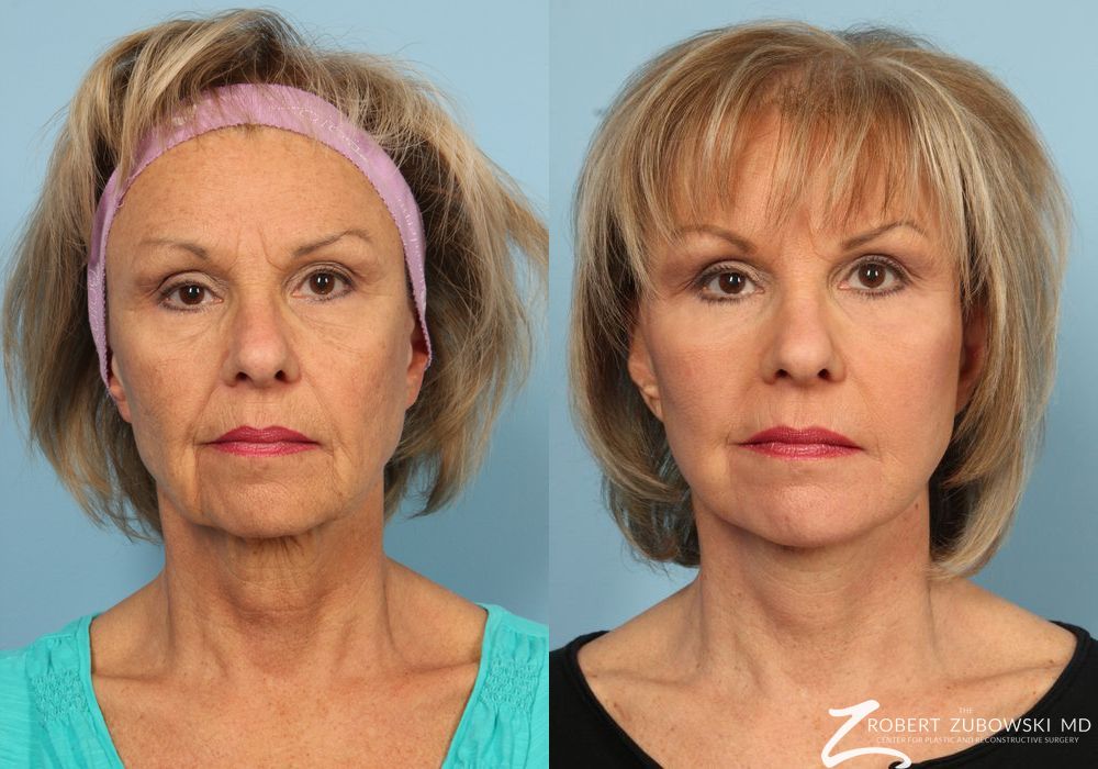 Facelift - Case 3805