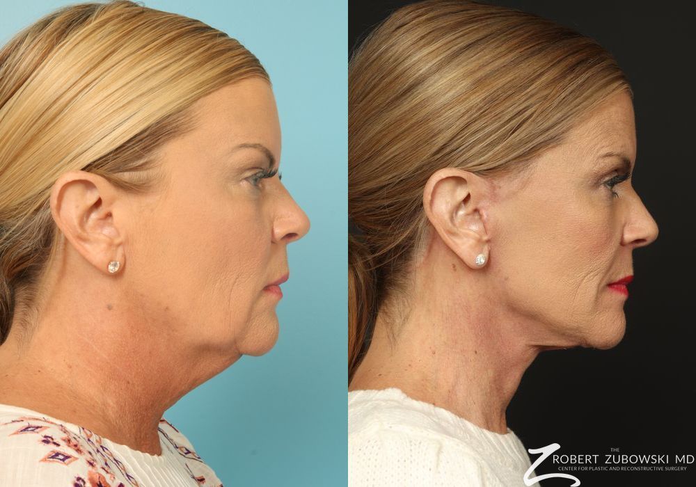 Facelift - Thumbnail 3