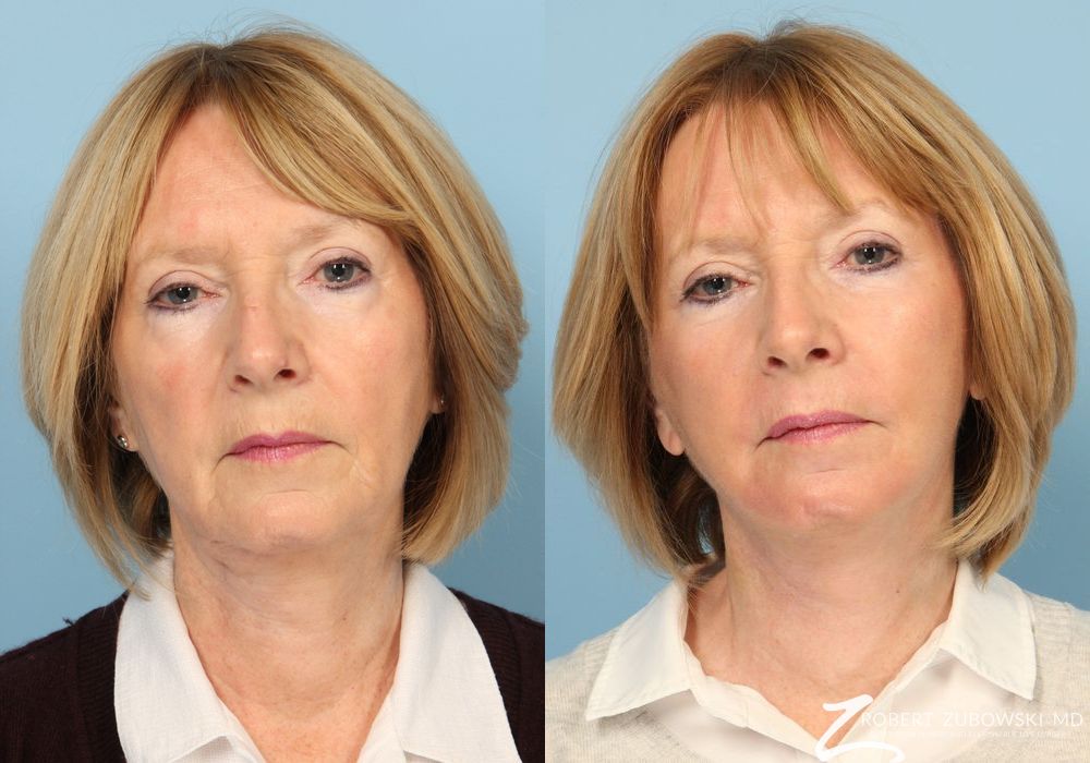 Facelift - Case 3814