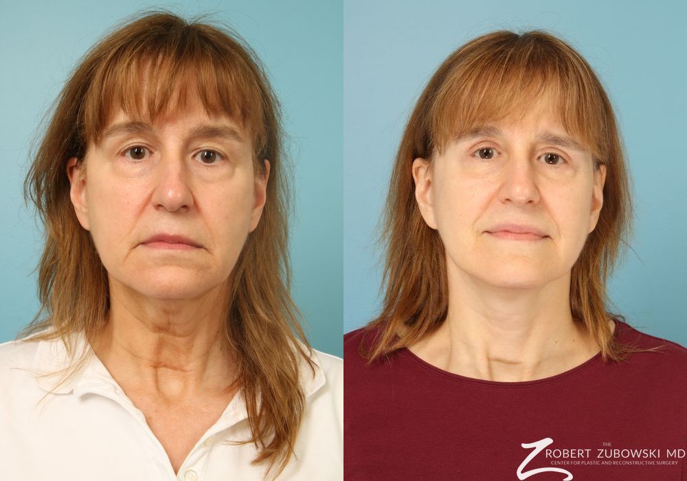 Facelift - Case 3826