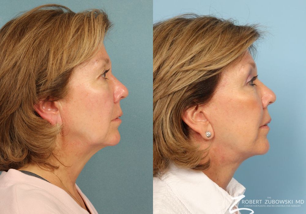 Facelift - Thumbnail 2