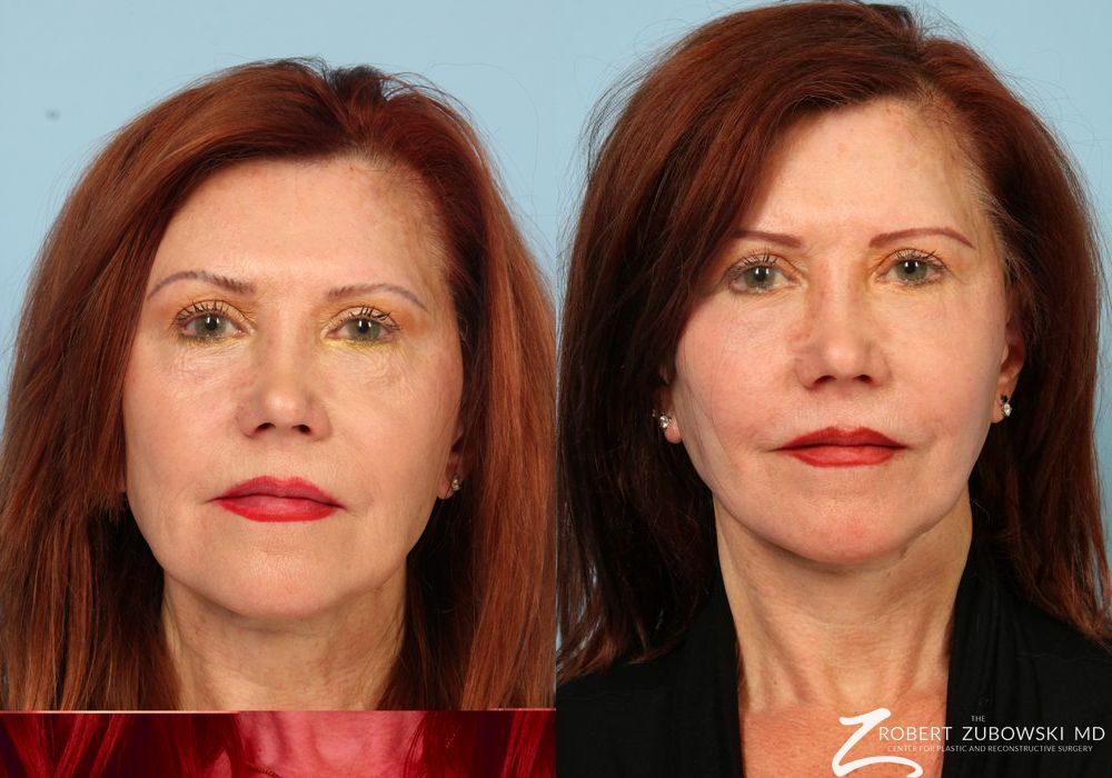 Facelift - Case 3822