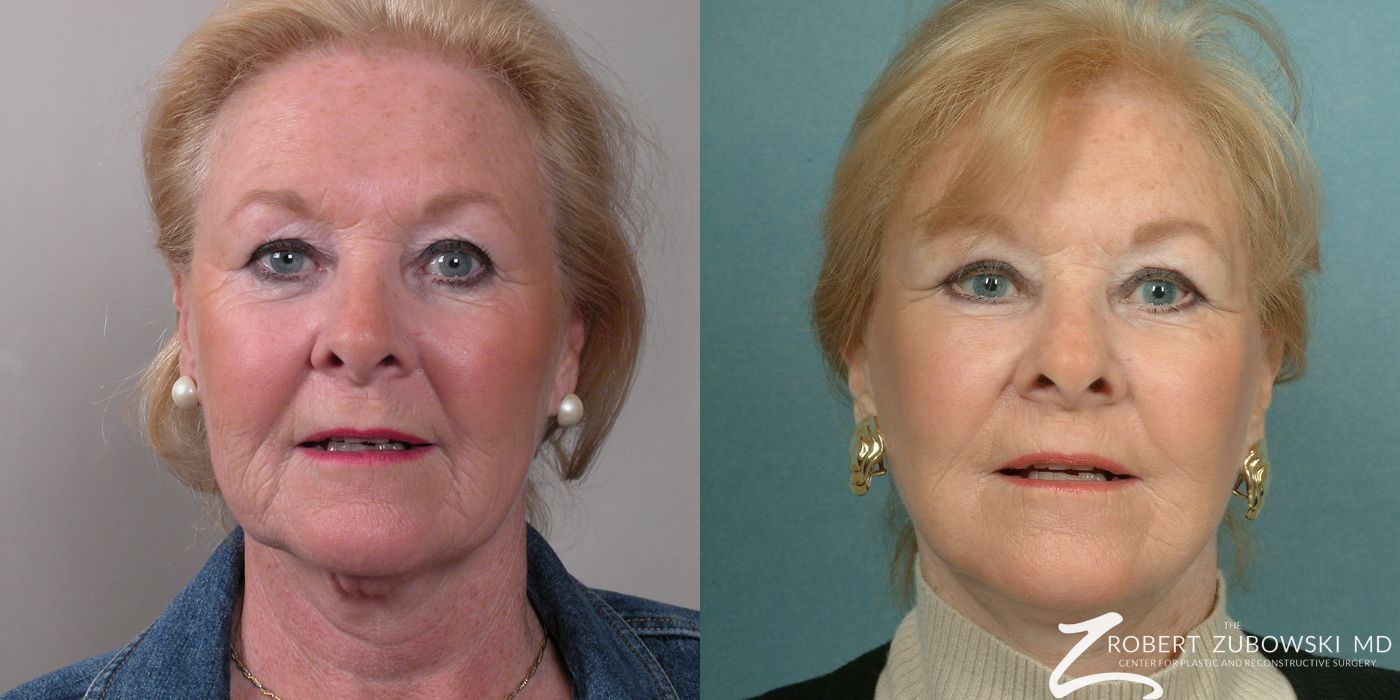 Facelift - Case 3809