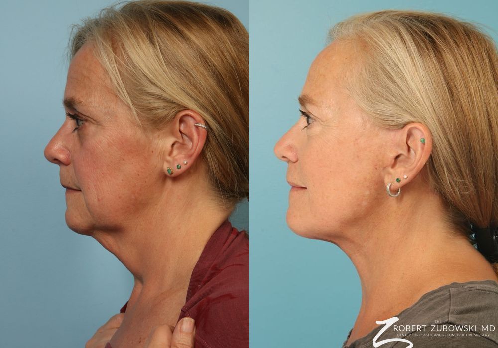 Facelift - Thumbnail 2