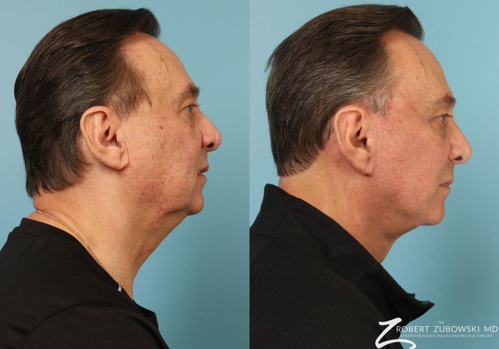 Facelift - Thumbnail 2