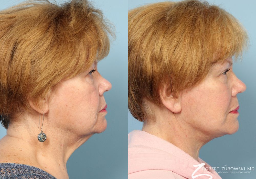 Facelift - Thumbnail 2