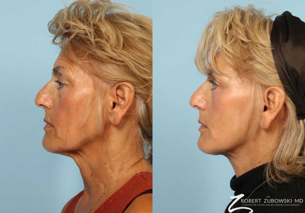 Facelift - Thumbnail 2