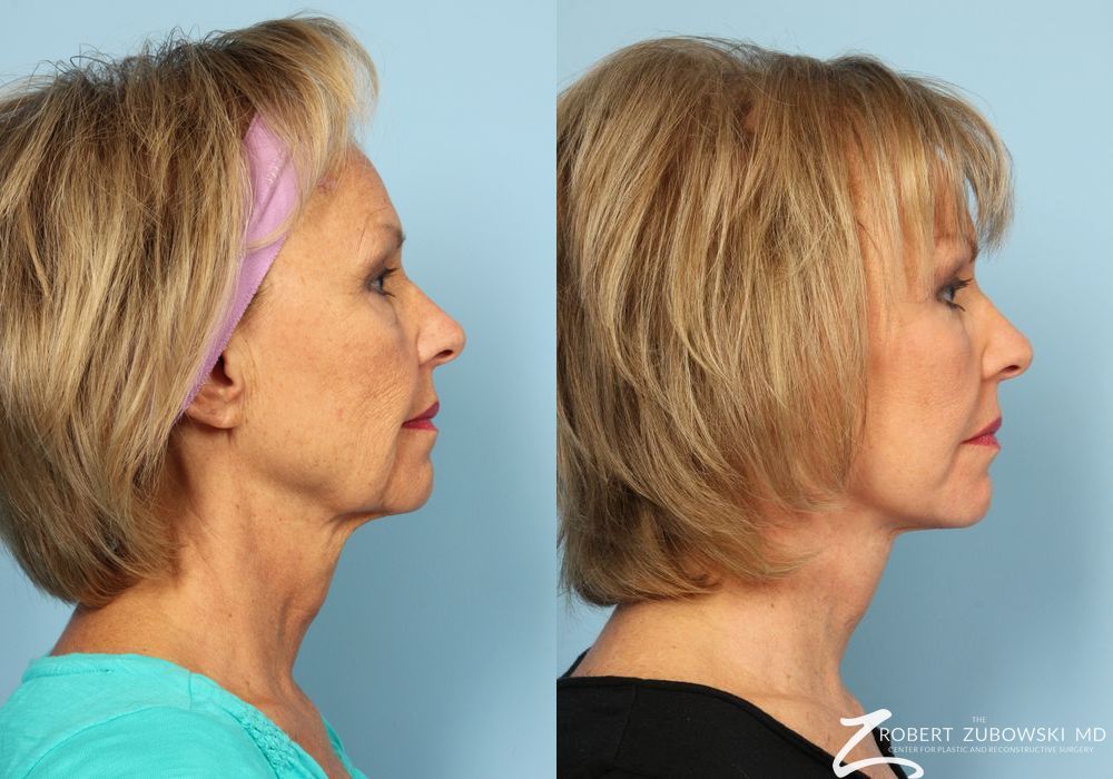 Facelift - Thumbnail 2