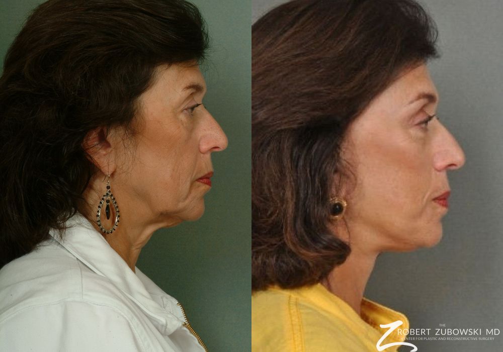 Facelift - Thumbnail 2