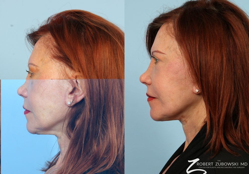 Facelift - Thumbnail 2