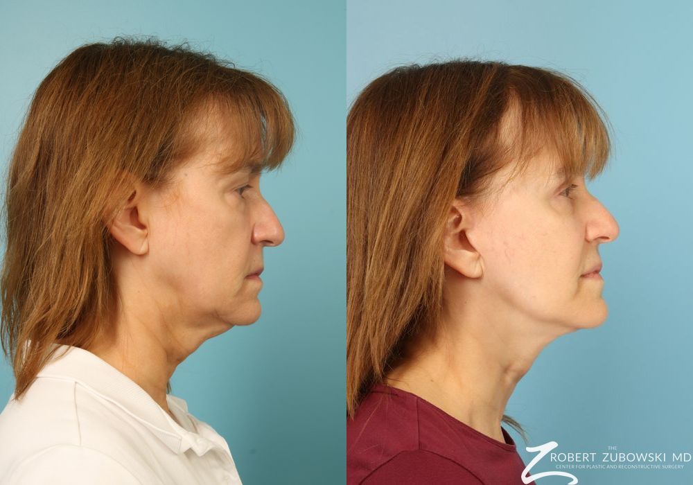 Facelift - Thumbnail 2