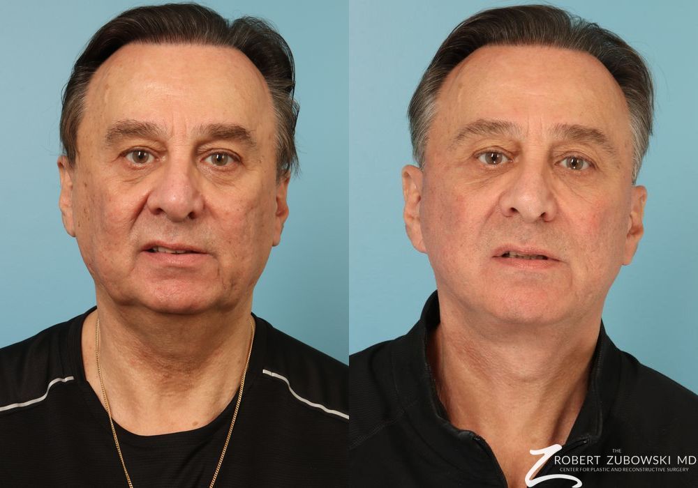 Facelift - Case 3827