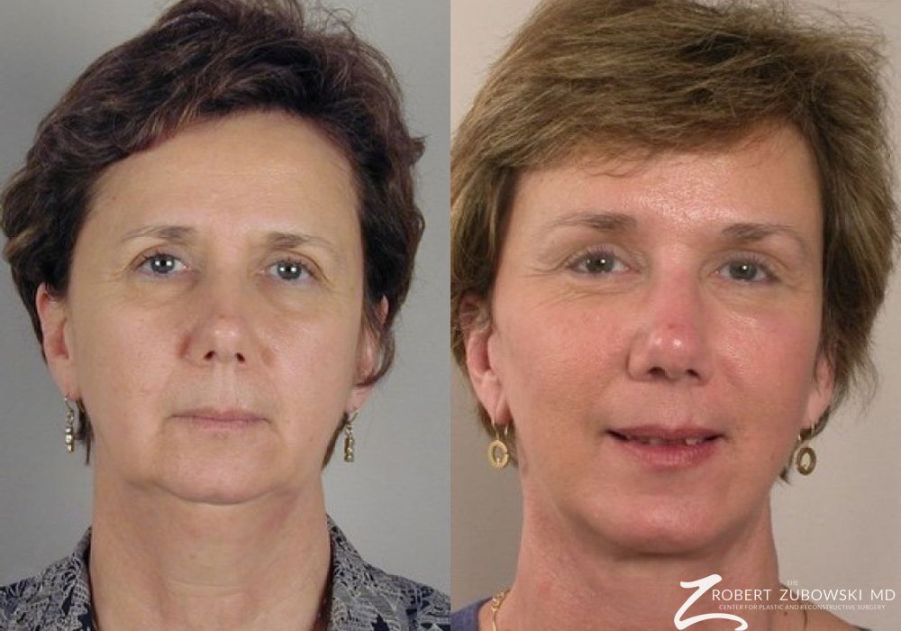 Before and after procedure result