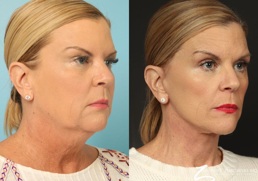 Facelift - Thumbnail 2