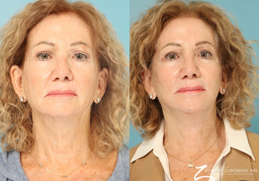 Facelift - Case 3825