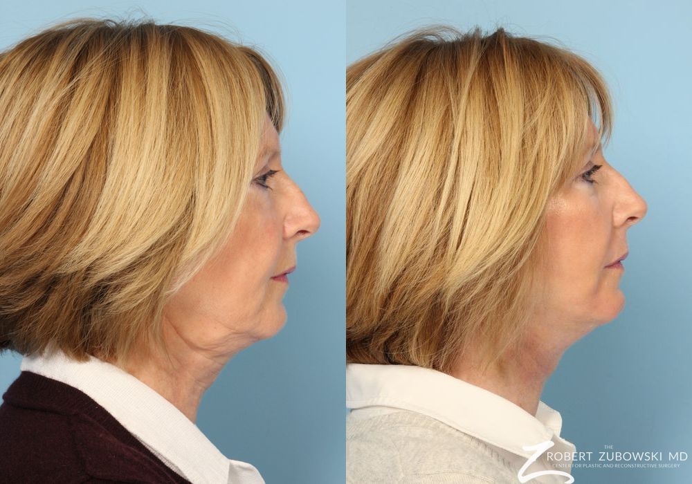 Facelift - Thumbnail 2