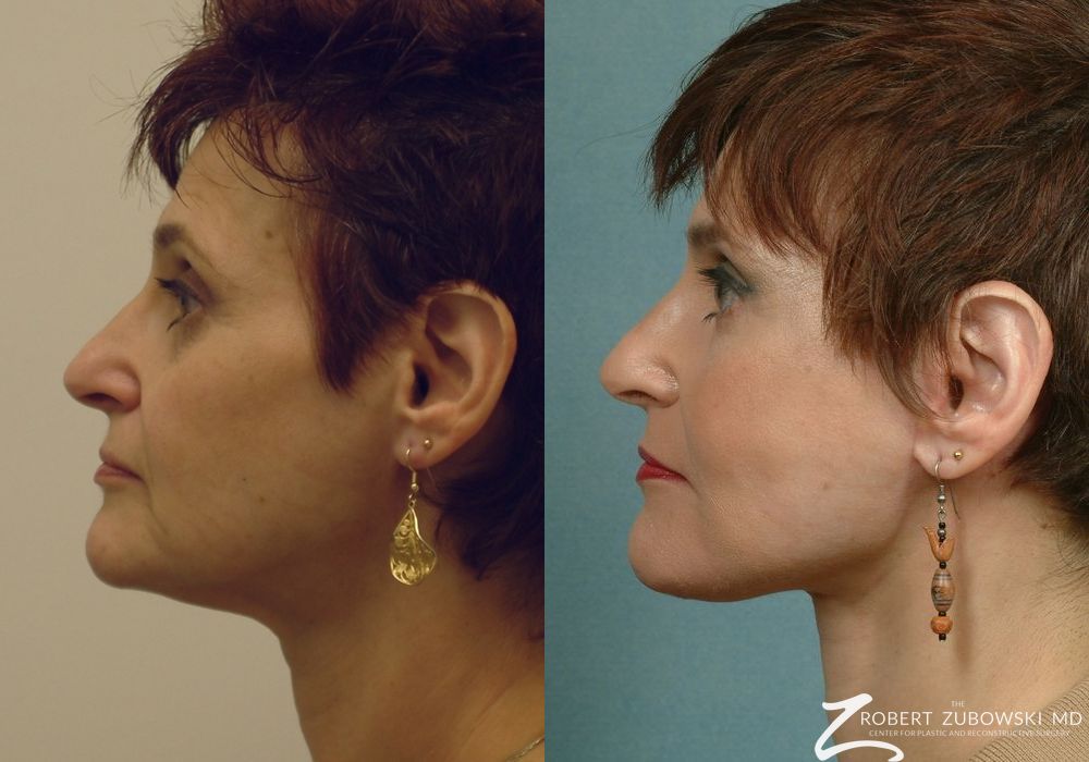 Facelift - Thumbnail 2