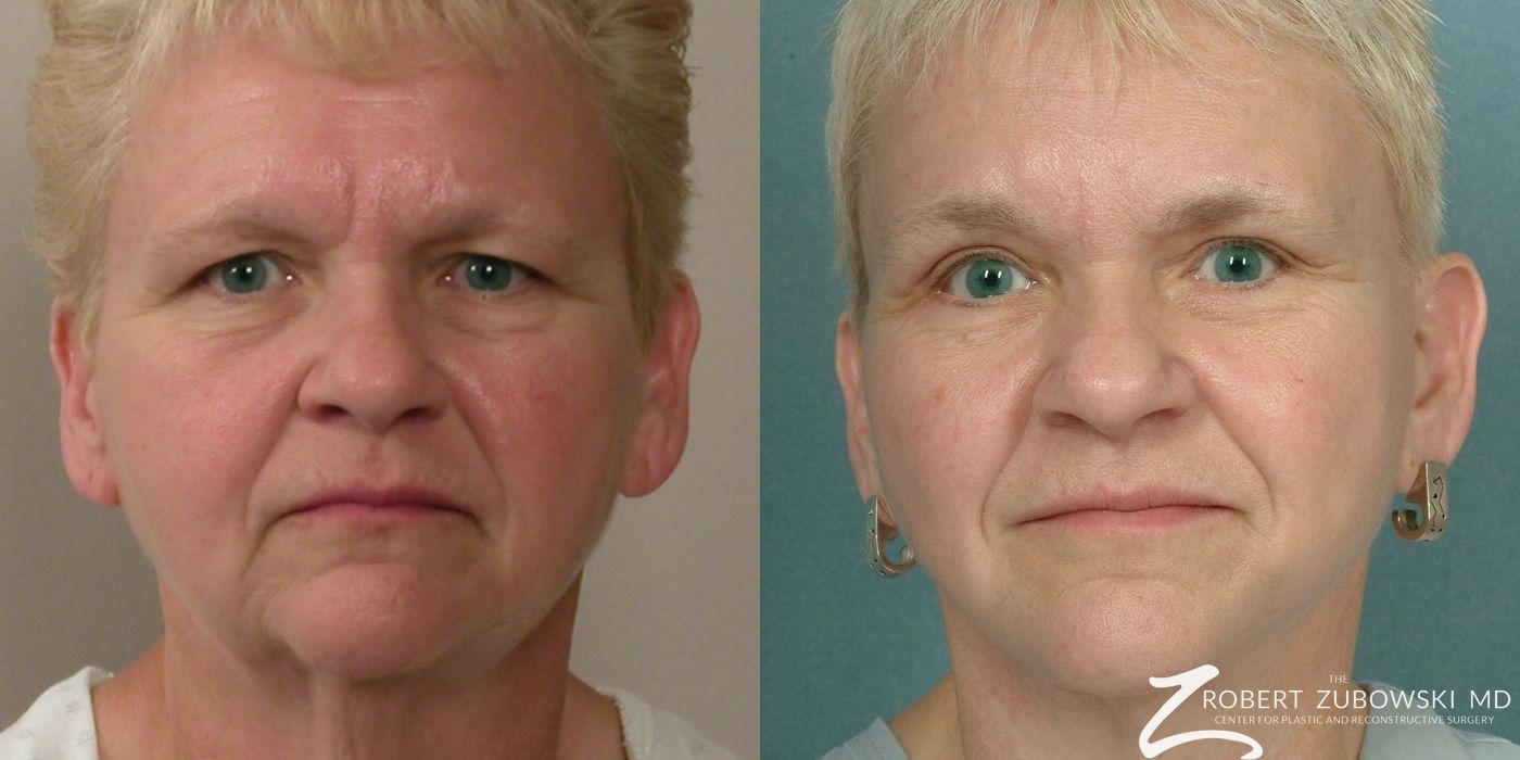 Facelift - Case 3808