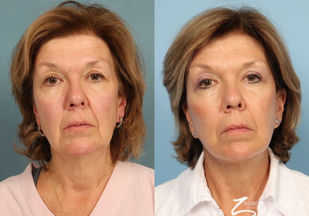 Facelift - Case 3812