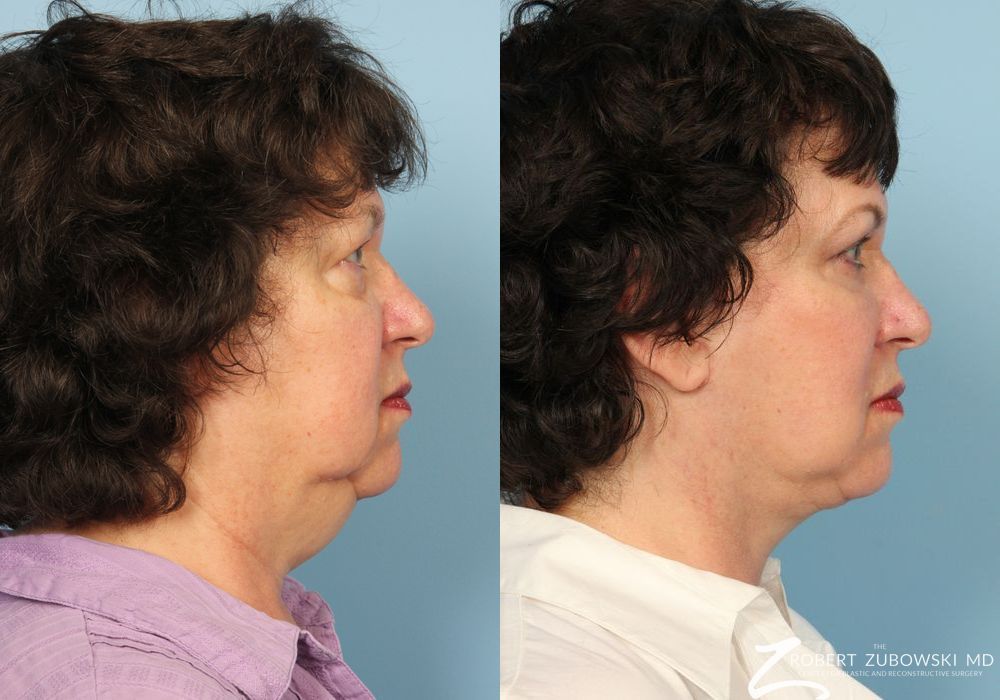 Before photo - Angle 2