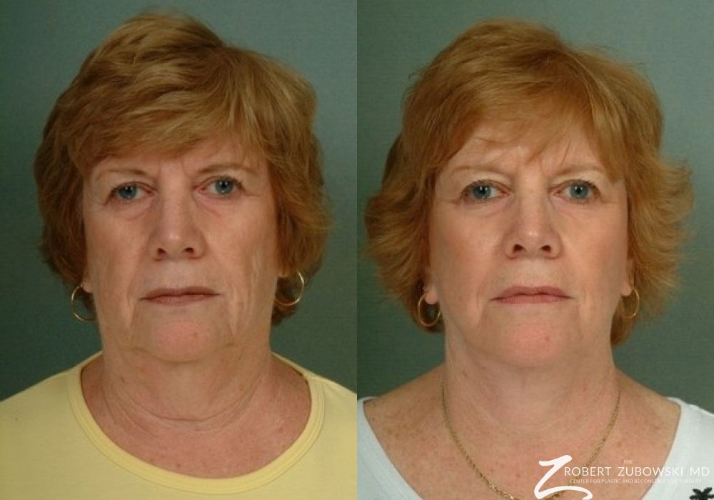 Before and after procedure result