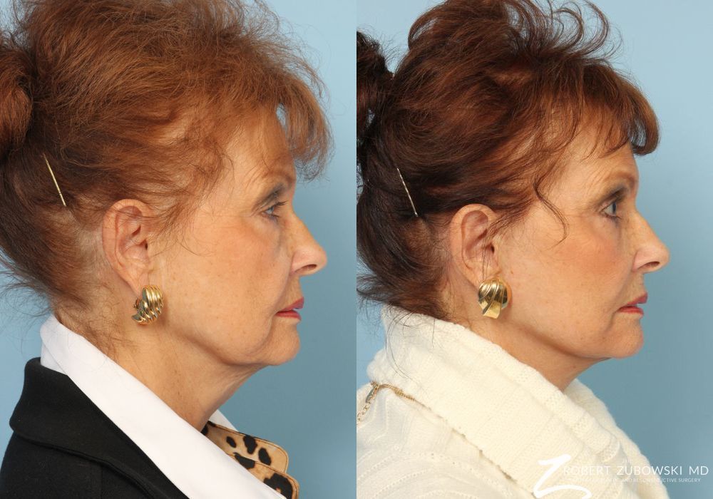 Facelift - Thumbnail 2