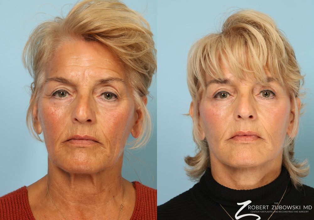 Facelift - Case 3823