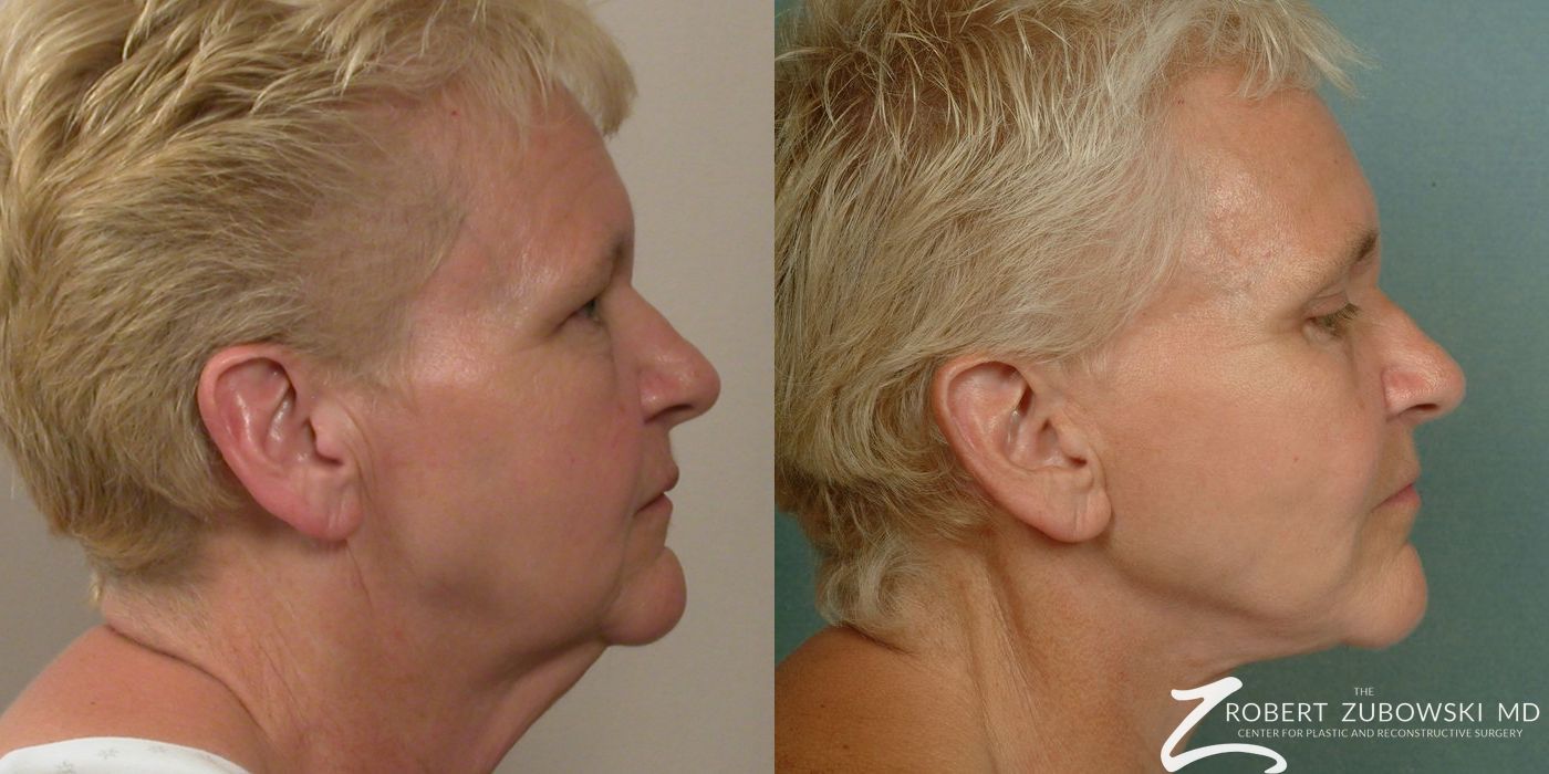 Facelift - Thumbnail 2