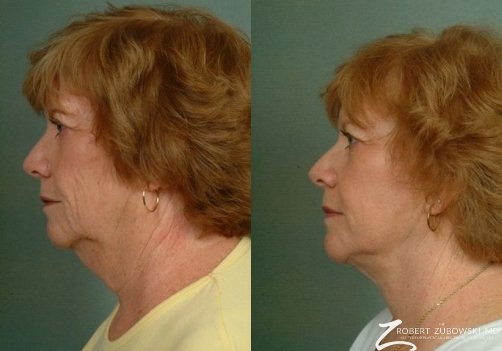 Facelift - Thumbnail 2