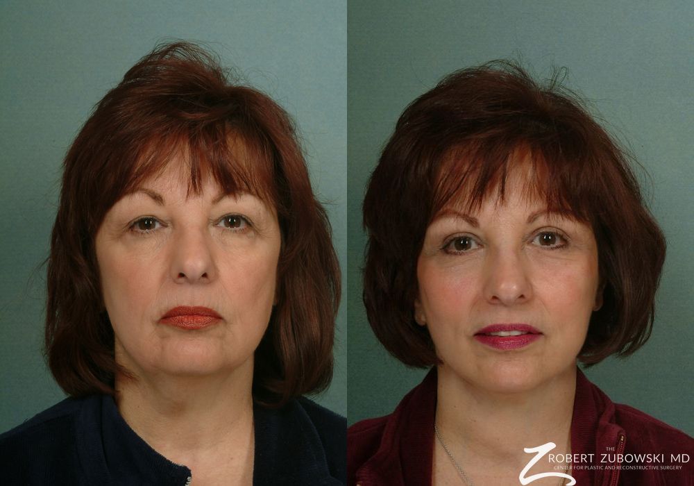 Facelift - Case 3803