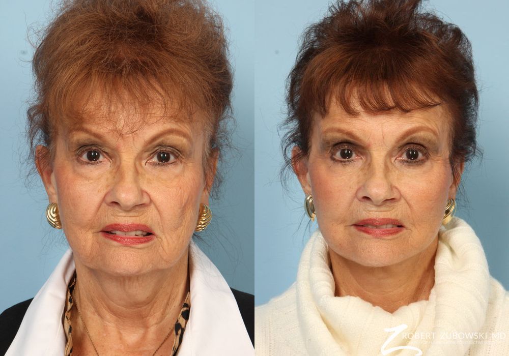 Facelift - Case 3820